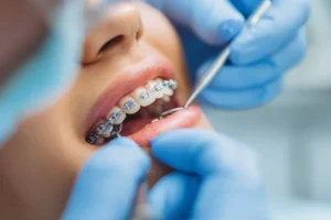 Mujer en tratamiento de ortodoncia. Brackets metálicos vs. Cerámicos