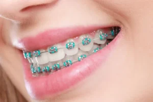 Mujer sonriendo, con tratamiento de Brakets. Ortodoncia de autoligado: ¿en qué se diferencia de los brackets convencionales?